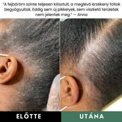 Természetes Fejbőrradír